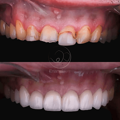 Smile Design and dental crowns enhance tooth shape and aesthetics for a natural balanced smile look.